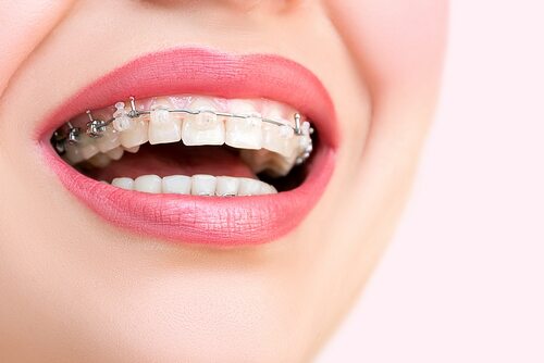 A girl smiling with clear braces