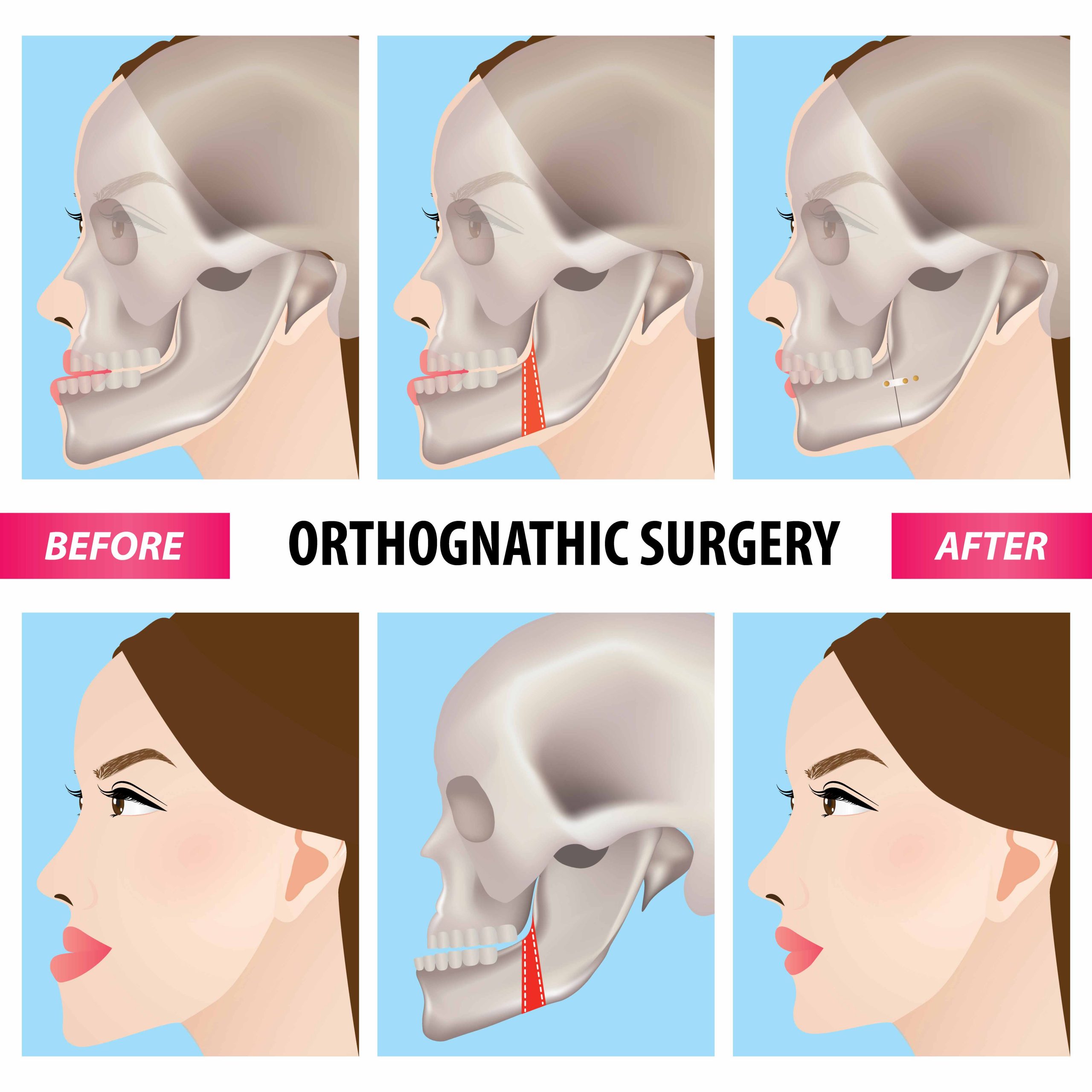 Orthognathic Surgery - orthodontic care at The Wireworks