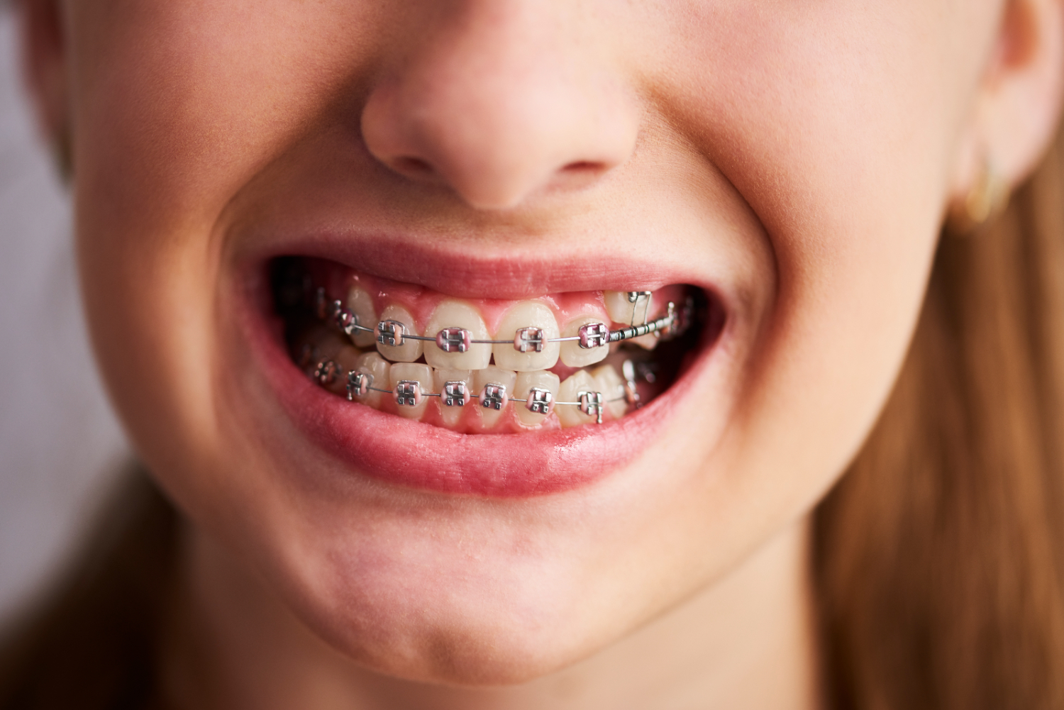 Crowded Teeth