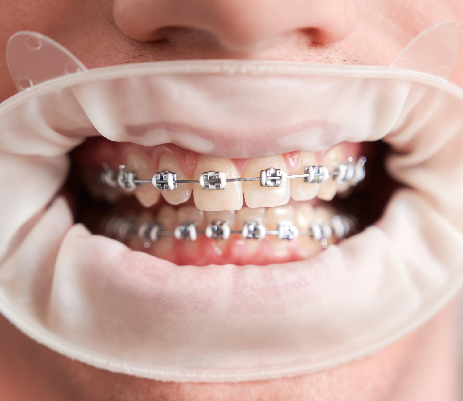 3439 - The Wireworks Orthodontics