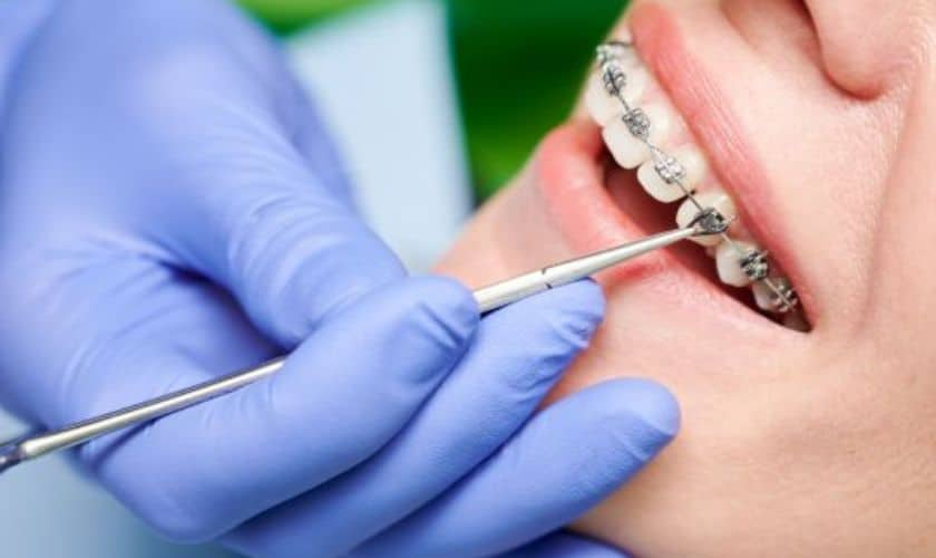 Can Adults Get Braces? Exploring Adult Orthodontics in Toronto