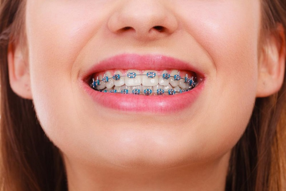 Expert Tips for Choosing the Right Orthodontist in Barrie